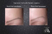 Удаление татуировок и татуажа в Алматы