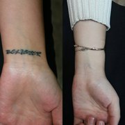 Лазерное удаление татуировок и татуажа в Алматы